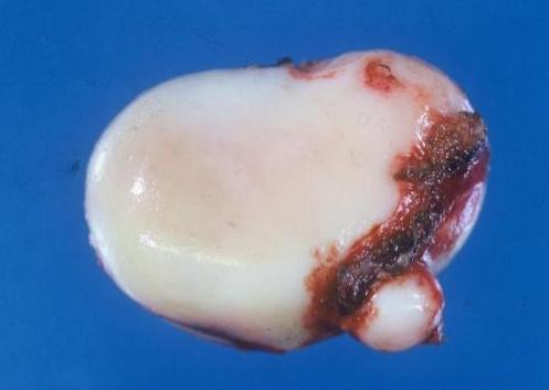 腹膜中皮腫の手術で摘出された腫瘍