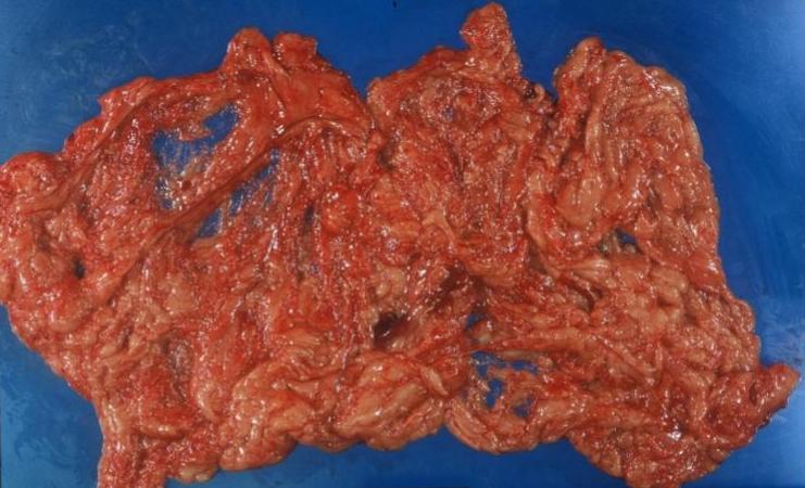 腹膜中皮腫の手術で摘出された腹膜播種